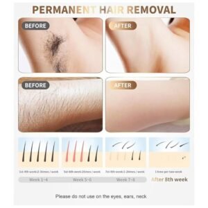 Before and after results of permanent hair removal using IPL technology